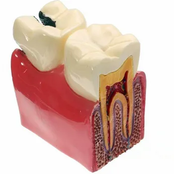 Студент-стоматолог Обучает практике Модель зубов 6-Кратное сравнение модели кариеса Демонстрационный модуль для изучения заболеваний  5